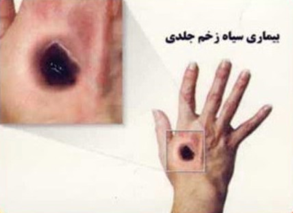 بیماری سیاه زخم در انسان